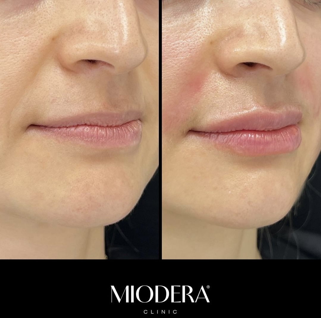 marirea buzelor cu acid hialuronic