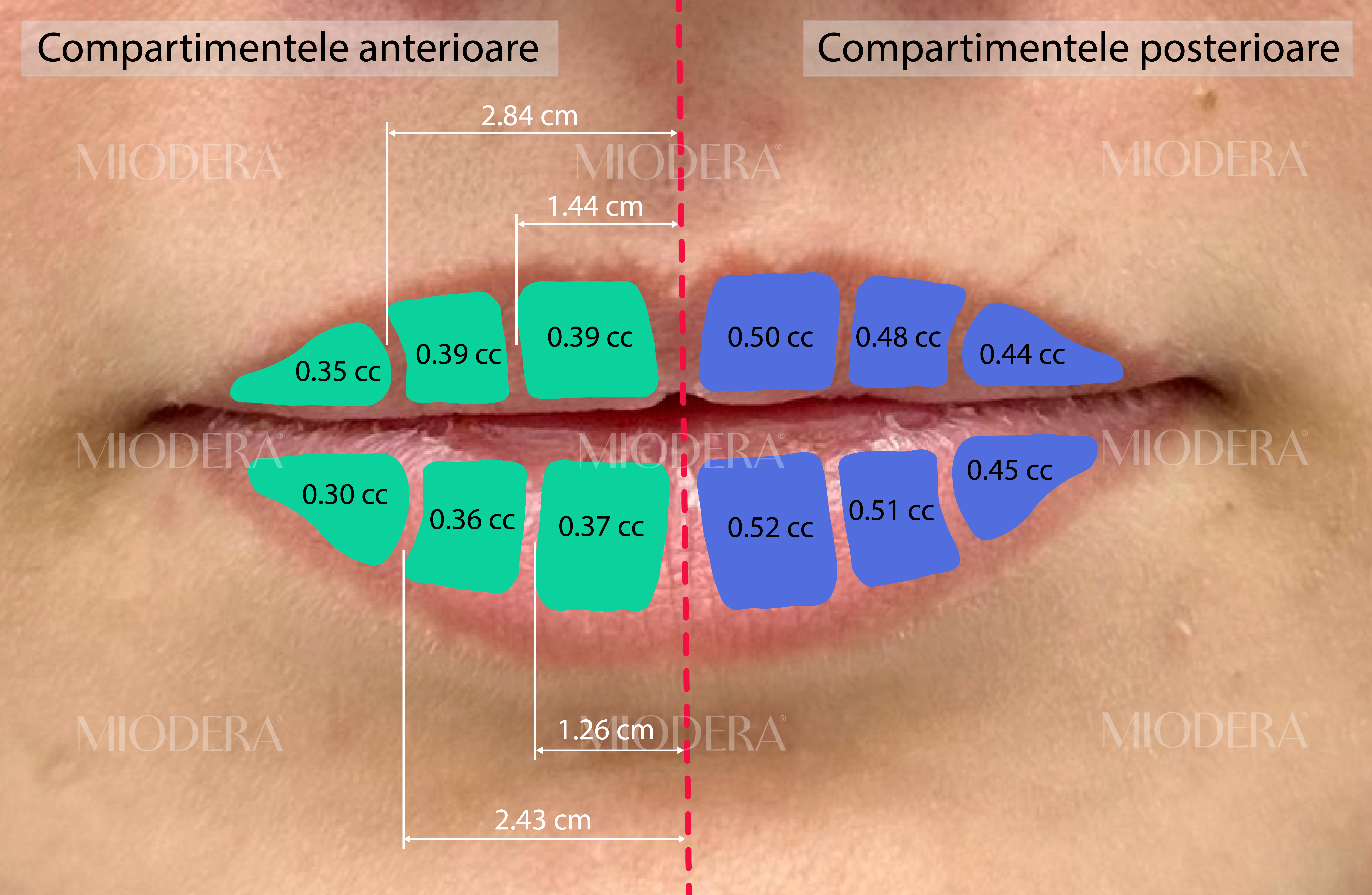 compartimente-buze-injectare-acid-hialuronic