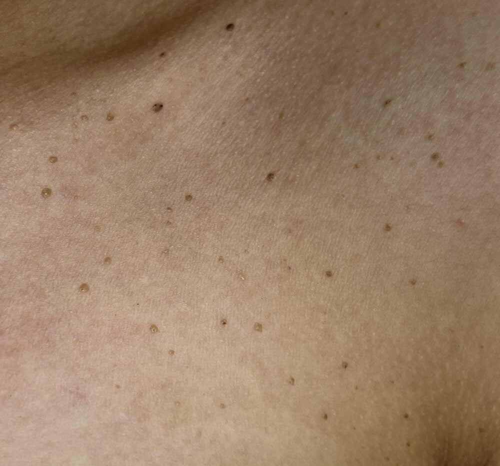 Papiloame / Condiloame: Tratament și Prevenție | Miodera Clinic