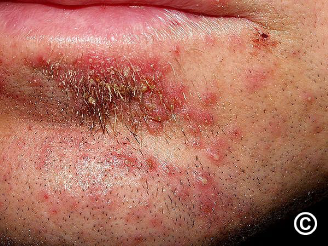 Sicosis - Foliculita staphylococcică a bărbii 4 Sicosis - Foliculita staphylococcică a bărbii