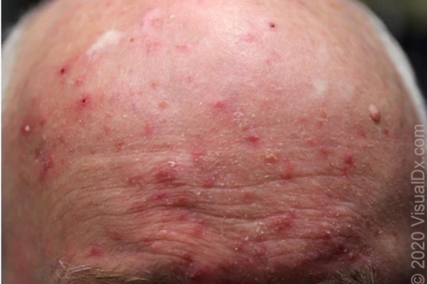 Infectious folliculitis-fig12 10 Infectious folliculitis-fig12