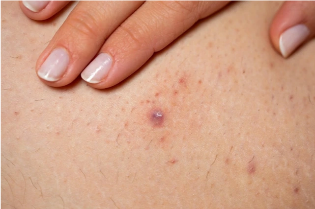 Ingrown-hairs-fig14 12 Ingrown-hairs-fig14