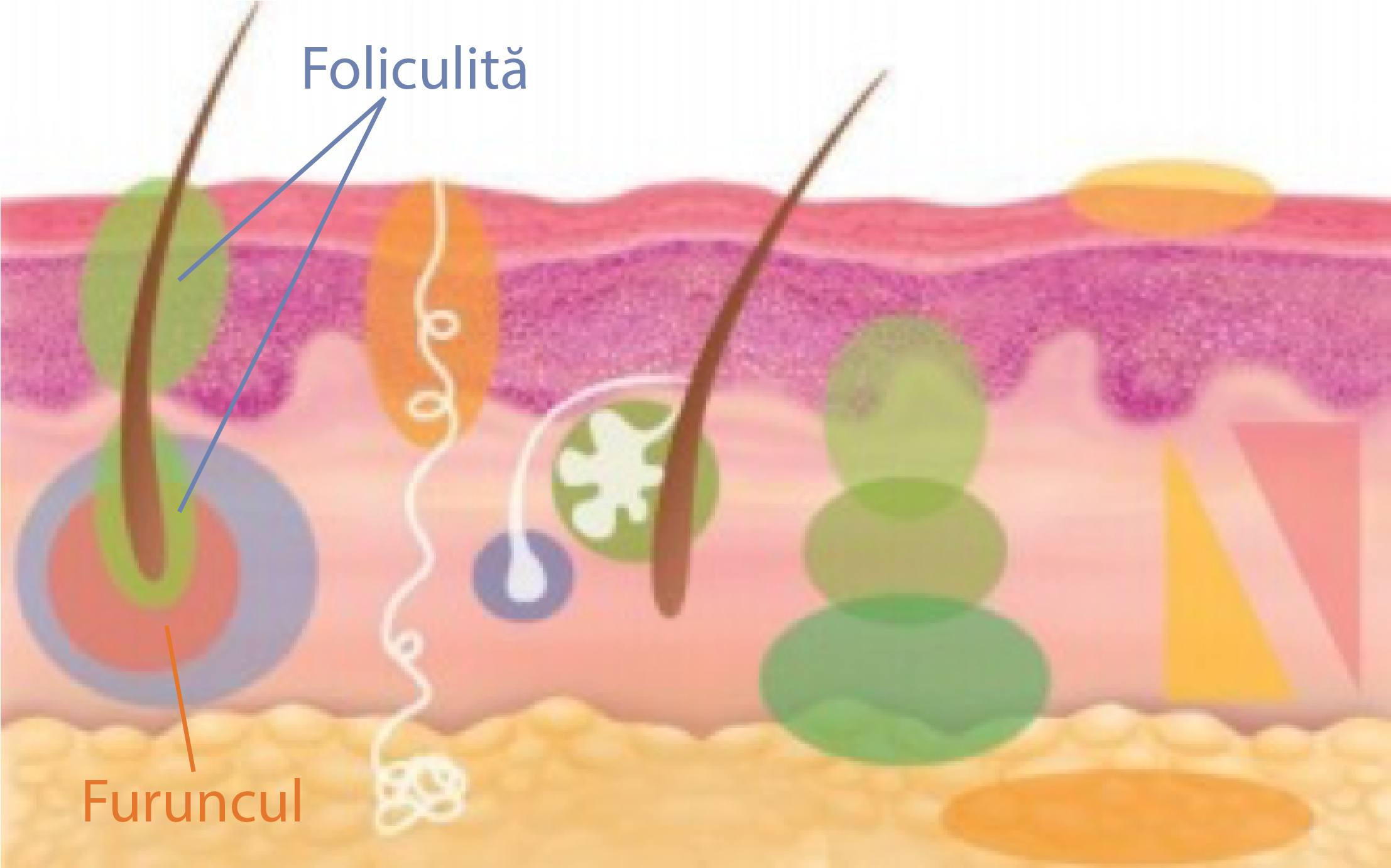 foliculita-furuncul-miodera 2 foliculita-furuncul-miodera