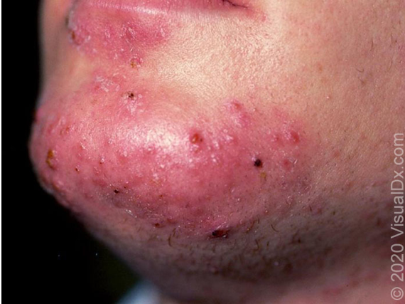 foliculita infectioasa fig9 7 foliculita-infectioasa-fig9