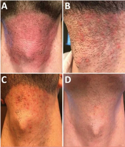 pseudofolliculitis-barbae-fig15 13 pseudofolliculitis-barbae-fig15