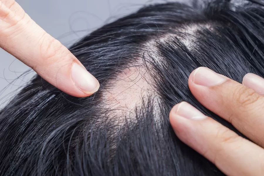 Deficiența de vitamină D, implicații asupra pielii și părului 11 alopecia