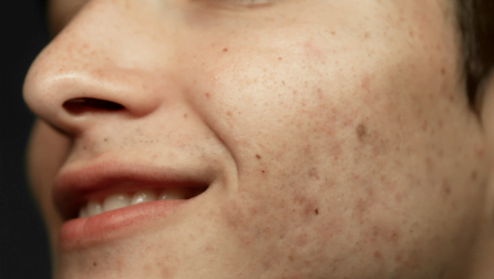 Pete hiperpigmentare 10 Pigmentări post-inflamatorii
