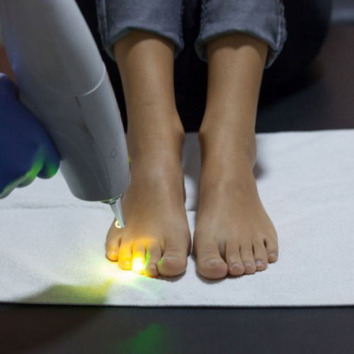 Onicomicoze 10 micoza unghiei - tratament laser co2