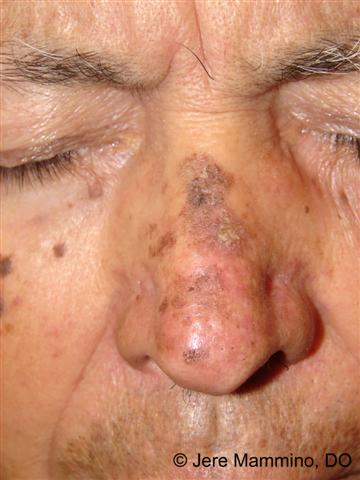 Pete hiperpigmentare 7 Keratoze actinice pigmentate