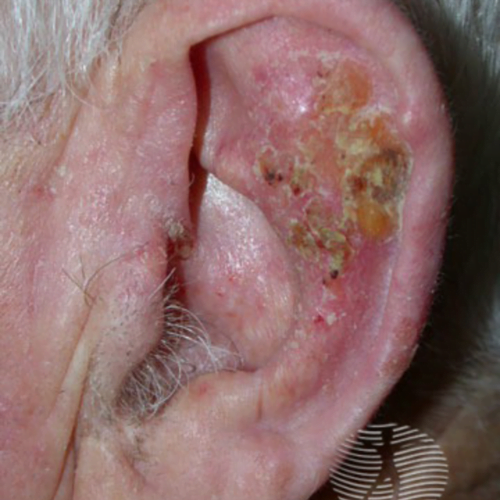 Pete hiperpigmentare 8 Bowen’s pigmentat