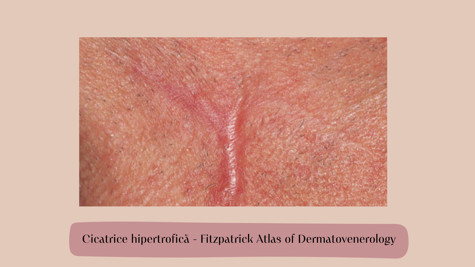 Cicatrice hipertrofica 1