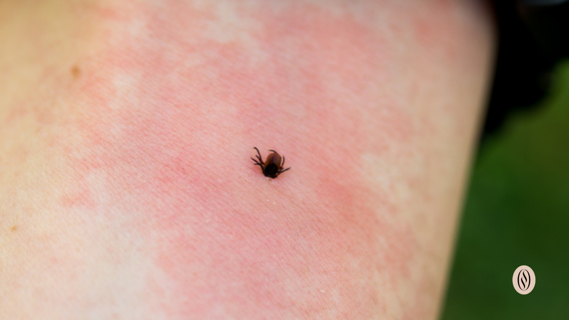 Reactie alergica la muscatura de capusa