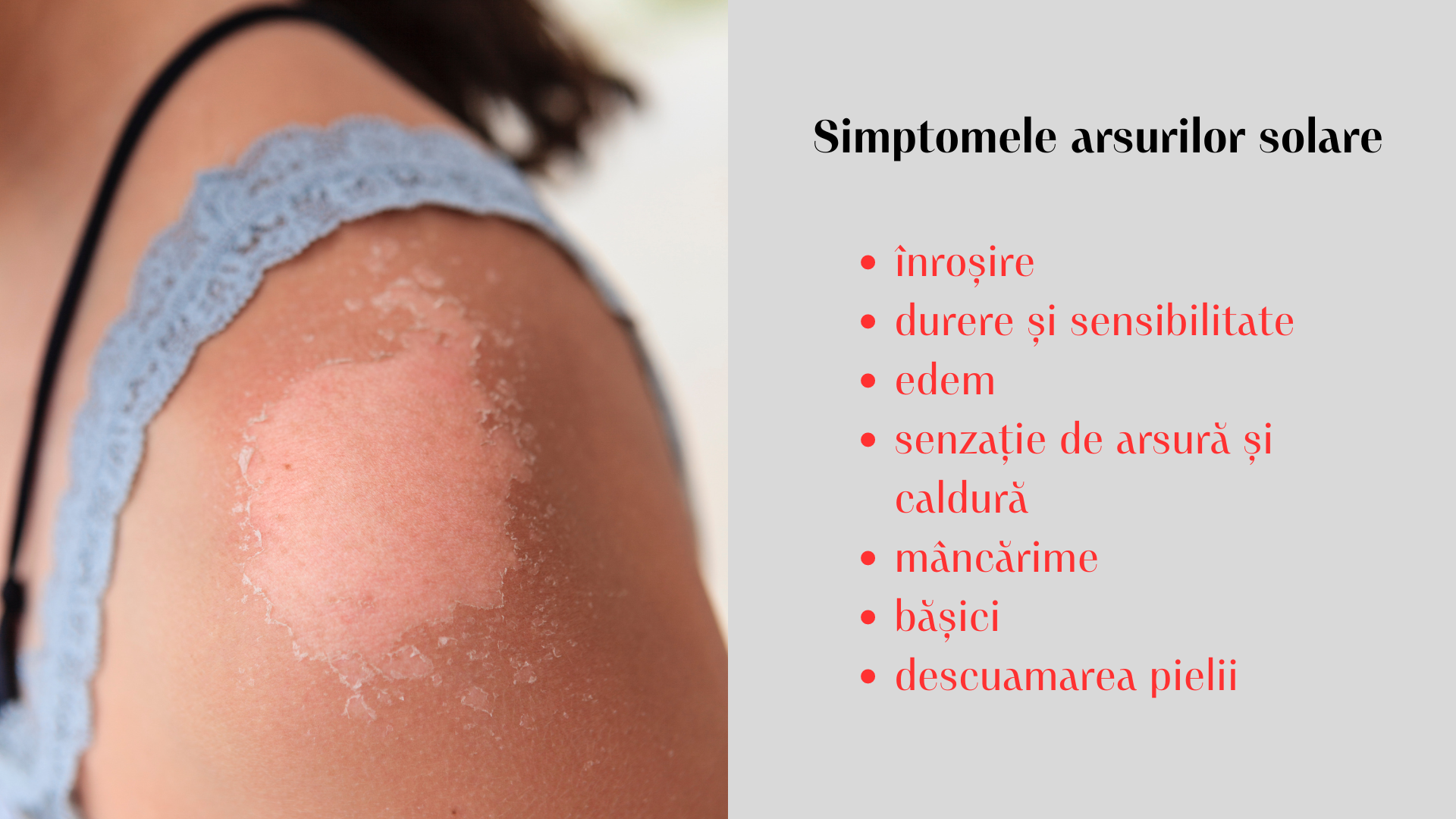 Arsurile Solare: cauze, simptome și tratamente eficiente 3 Simptomele arsurilor solare