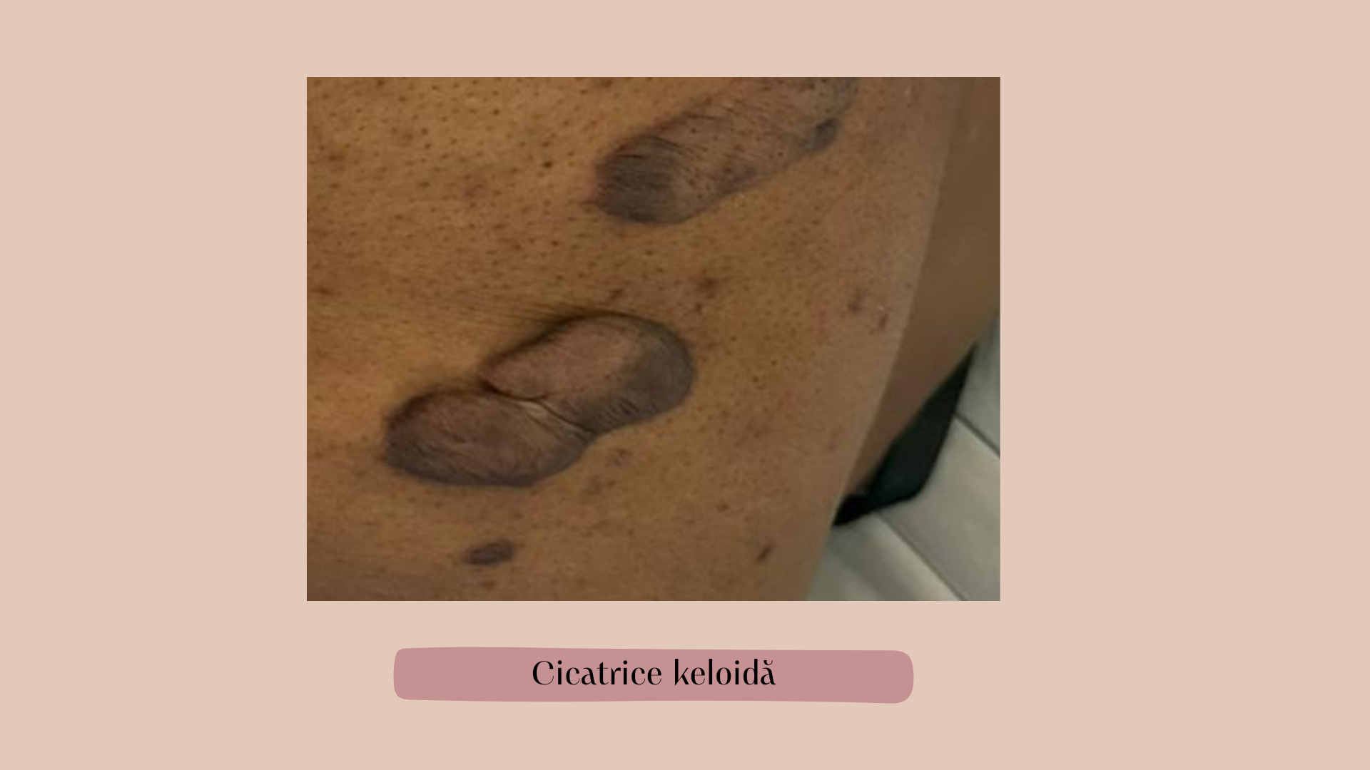 cicatrice keloida