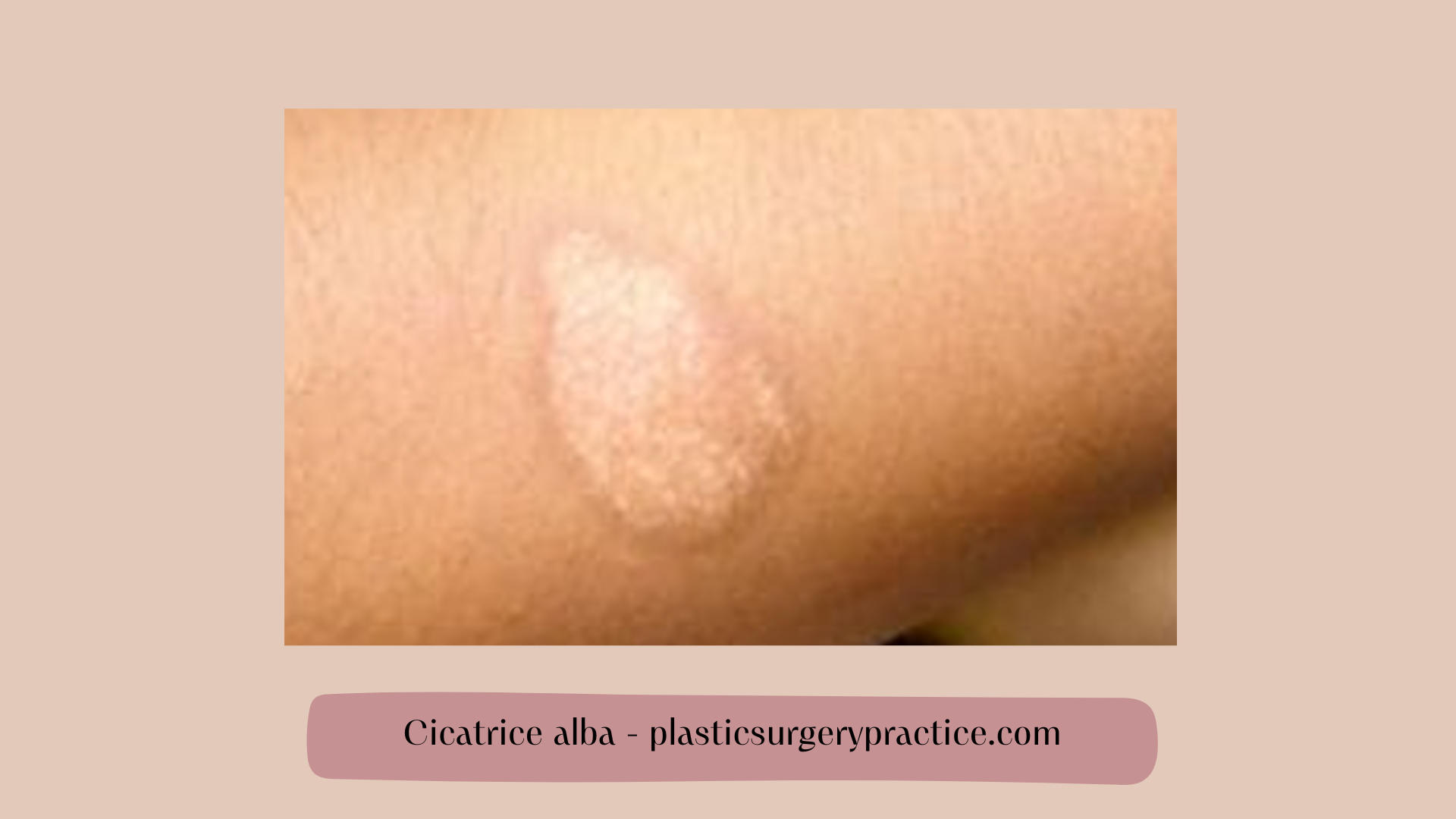 cicatrici albe