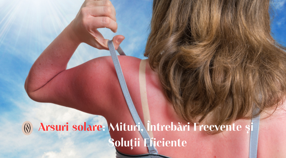 Arsuri solare: Mituri, Întrebări Frecvente și Soluții Eficiente 1 Arsuri solare Mituri Intrebari Frecvente si Solutii Eficiente
