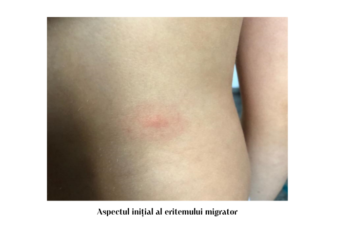 Căpușele: mituri, întrebări și răspunsuri 2 Aspectul initial al eritemului migrator 1