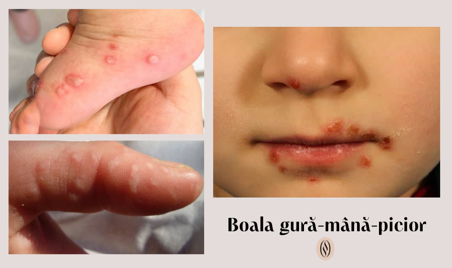 Boala Gură-Mână-Picior 1 Boala gura mana picior