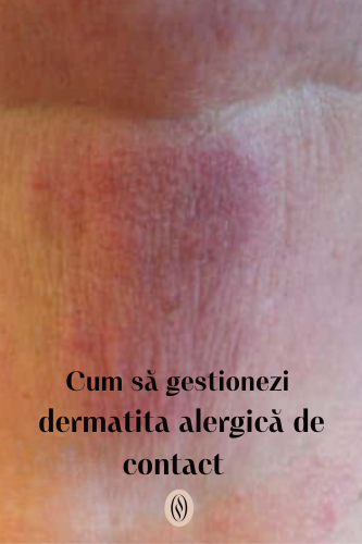 Cum să gestionezi dermatita alergică de contact 102 Cum gestionezi dermatita alergica de contact uai