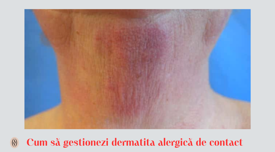 Cum să gestionezi dermatita alergică de contact 1 Cum sa gestionezi dermatita alergica de contact