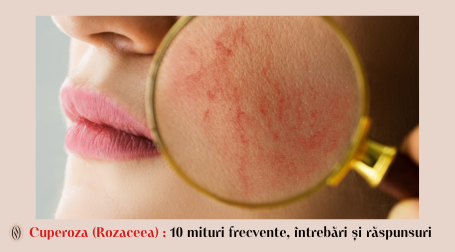 Cuperoza (Rozaceea): 10 mituri frecvente, întrebări și răspunsuri 1 Cuperoza Rozaceea 10 mituri frecvente intrebari si raspunsuri 1