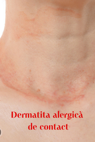 Dermatita alergică de contact: simptome și caracteristici 115 Dermatita alergica de contact alergie la metal uai