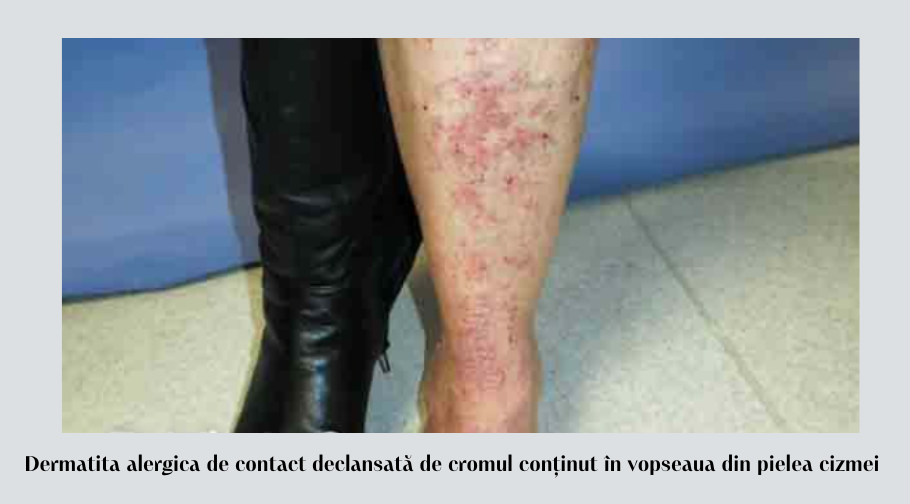 Cum să gestionezi dermatita alergică de contact 3 Dermatita alergica de contact declansata de cromul continut in vopseaua dini pielea cizmei