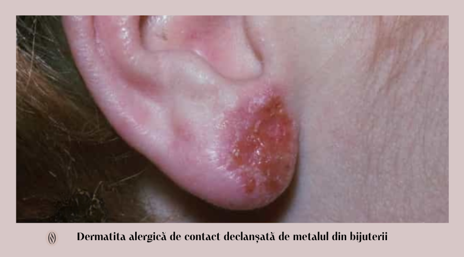 Dermatita alergică de contact: mituri, întrebări și răspunsuri 2 Dermatita alergica de contact declansata de metalul din bijuterii 1