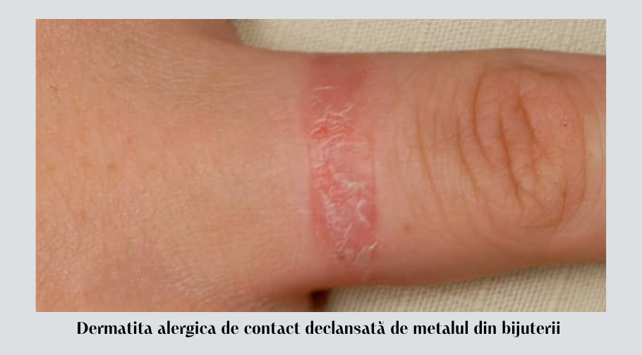 Cum să gestionezi dermatita alergică de contact 2 Dermatita alergica de contact declansata de metalul din bijuterii 2