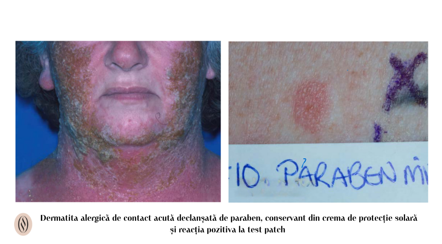 Tratamentul dermatitei alergice de contact 3 Dermatita alergica de contact declansata de paraben