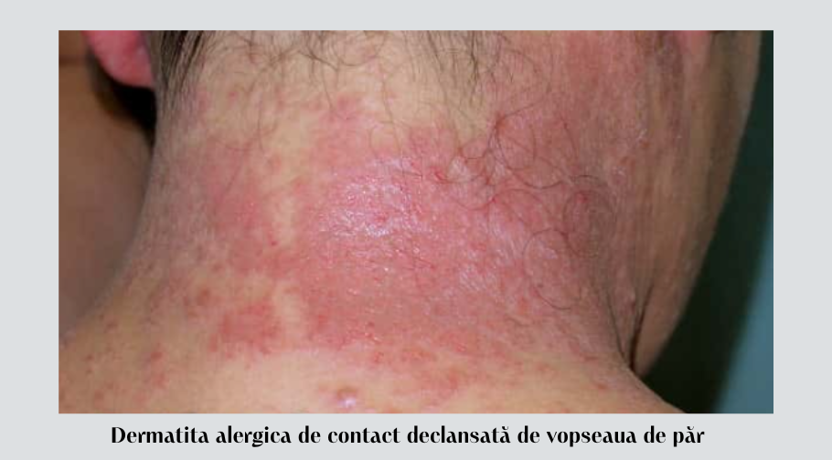 Cum să gestionezi dermatita alergică de contact 4 Dermatita alergica de contact declansata de vopseaua de par
