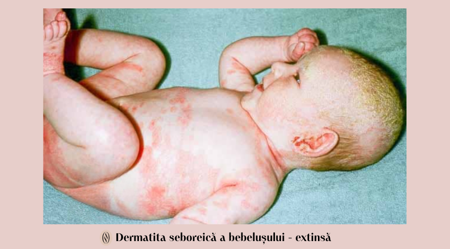 Dermatita seboreica a bebelusului