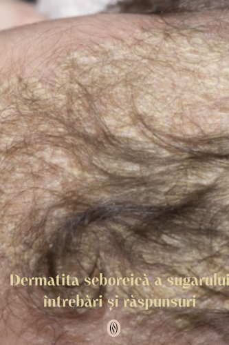 Dermatita seboreică a sugarului (crustele de lapte) : întrebări și răspunsuri 94 Dermatita seboreica a sugaruluii intrebari si raspunsuri 2 uai