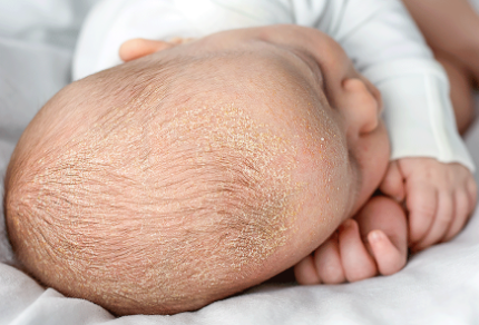 Dermatita seboreica a sugaruluii intrebari si raspunsuri