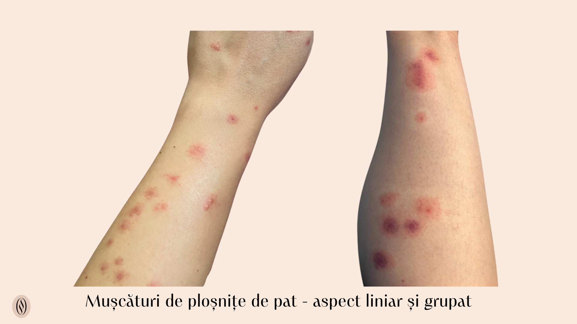 Plo ni ele De Pat Identificare Prevenire i Eliminare Eficient 