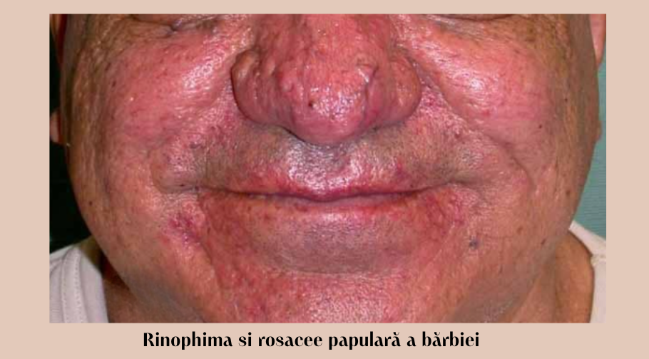 Cuperoza (Rozaceea): 10 mituri frecvente, întrebări și răspunsuri 2 Rinophima si rosacee papulara a barbiei