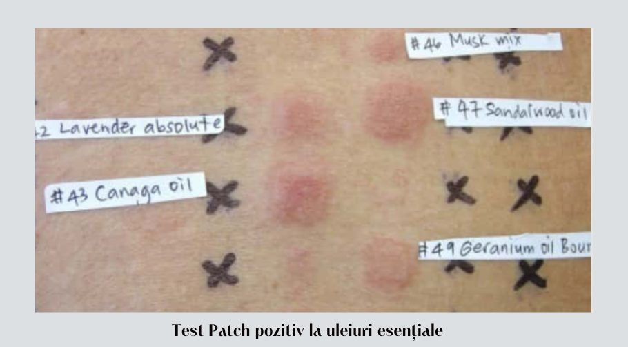 Cum să gestionezi dermatita alergică de contact 5 Test patch pozitiv la uleiuri esentiale
