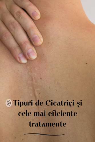 Tipuri de Cicatrici și Cele Mai Eficiente Tratamente 120 Tipuri de Cicatrici si Cele Mai Eficiente Tratamente 1 uai