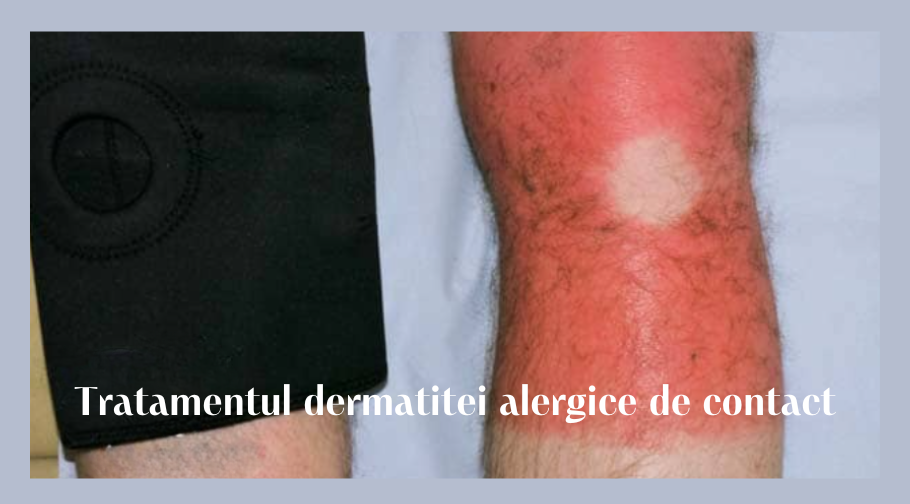 Tratamentul dermatitei alergice de contact 1 Tratamentul dermatitei alergice de contact