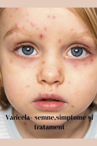 Varicela : semne, simptome și tratament 114 Varicela semne simptome si tratament uai