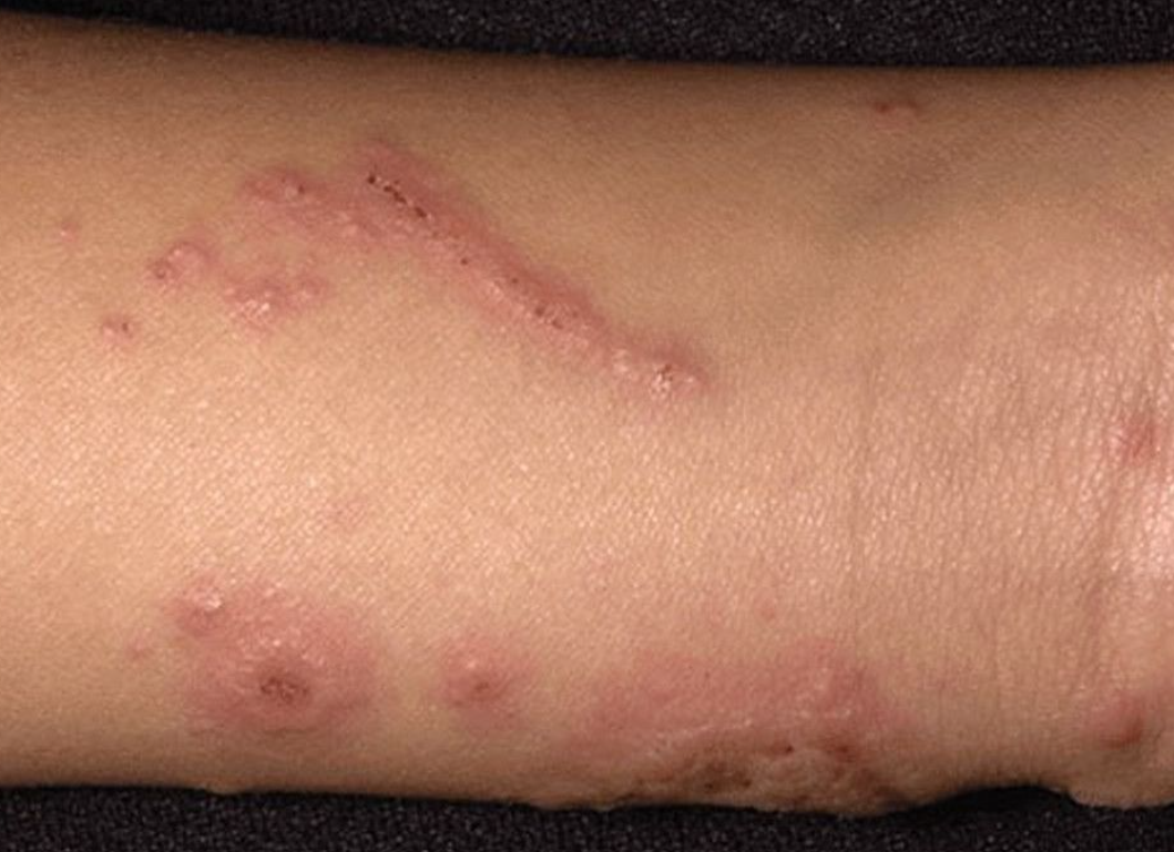 aspectul dermatitei alergice de contact
