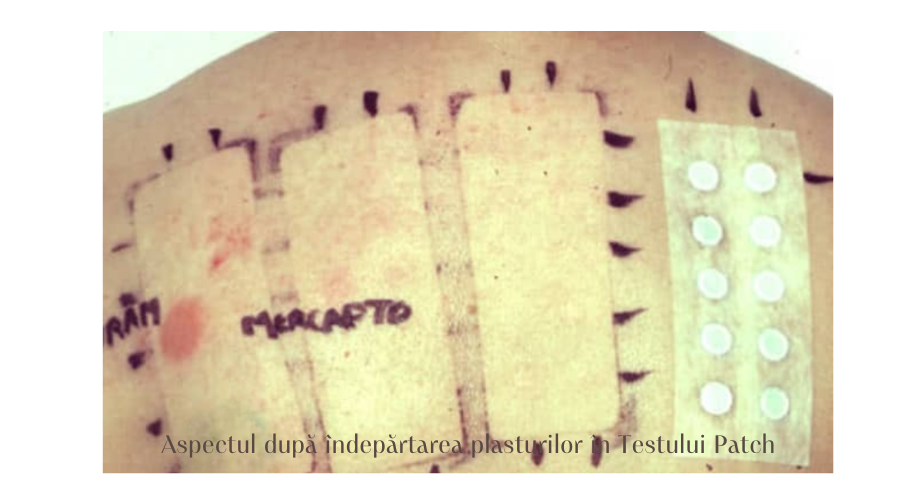 aspectul pielii dupa indepartarea plasturilor in patch test