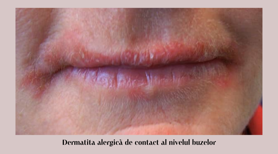 Dermatita alergică de contact: mituri, întrebări și răspunsuri 5 dermatita alergica de contact la nivelul buzelor