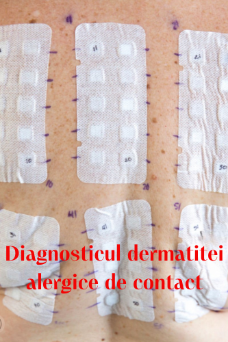 Diagnosticul dermatitei alergice de contact 117 dermatita alergica test patch uai