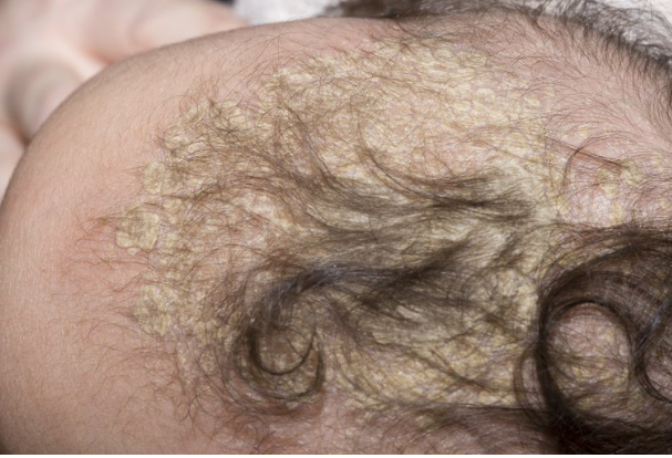dermatita seboreica a sugarului cruste de lapte