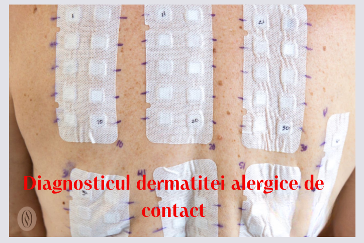diagnosticul dermatitei alergice de contact