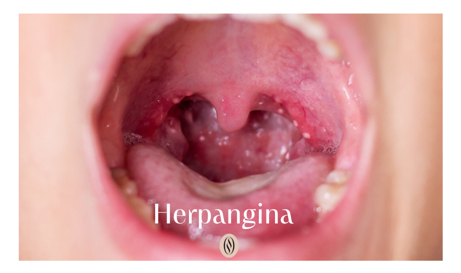 herpangina
