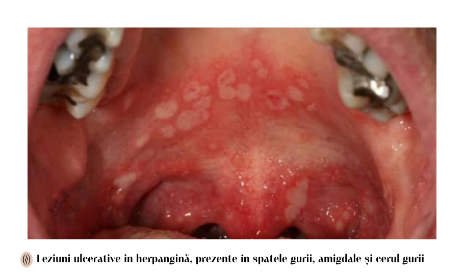 leziuni ulcerative in infectia virala herpangina