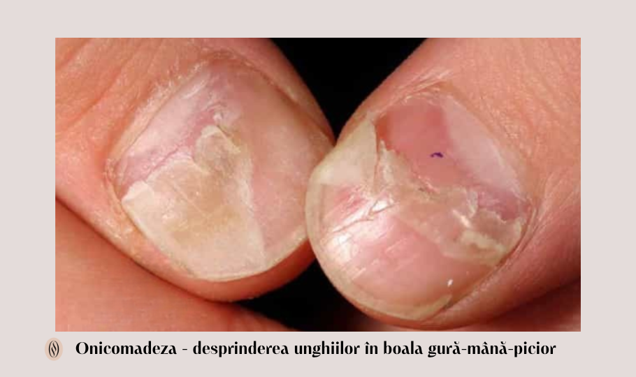 Boala Gură-Mână-Picior 4 onicomadeza in boal agura mana picior