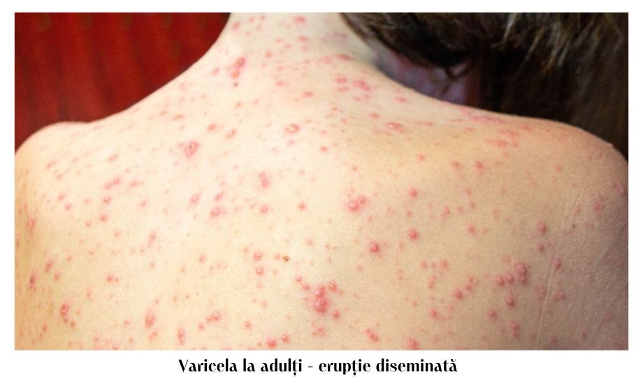 Varicela : semne, simptome și tratament 5 varicela la adulti